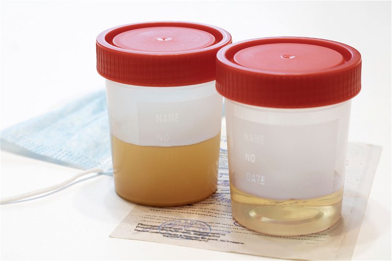 Citološka analiza urina